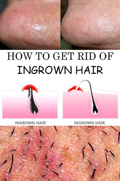 ingrown hair ingrown hair