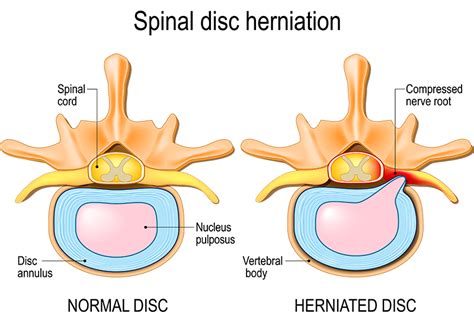 dont delay  diagnosis   herniated disk virginia spine specialists