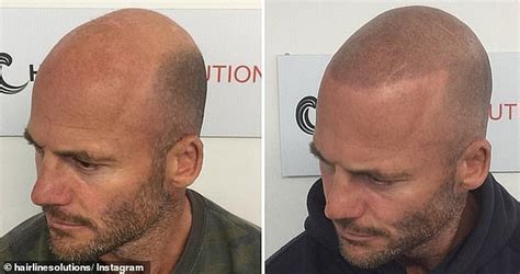 Balding Men Are Flocking To Get Their Heads Tattooed After Mike Gunner