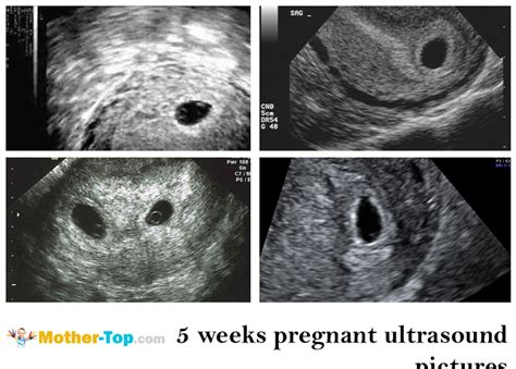 pregnancy  weeks ultrasound pregnancywalls