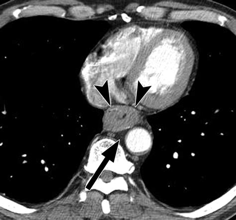 Multimodality Assessment Of Esophageal Cancer Preoperative Staging And