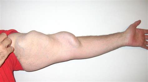 fistula protector wristband kidneybuzz