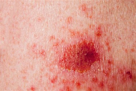 Skin Lesions May Precede A Diagnosis Of Waldenström Macroglobulinemia
