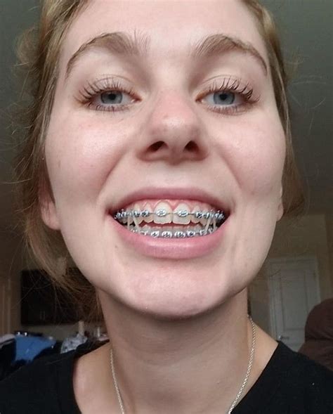 Braces Girlswithbraces Metalbraces Elastics Aparelho Dental