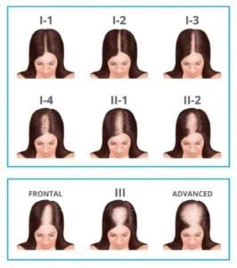 female pattern hair loss trichology centre