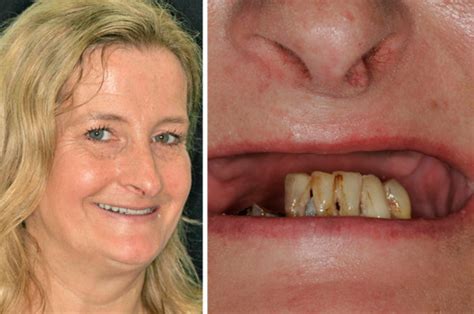 woman goes to dentist to have crowns fitted ends up with no top teeth