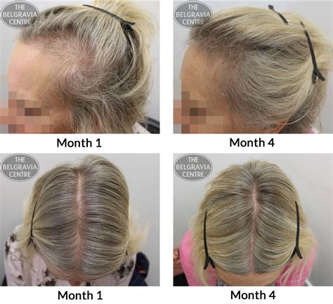 female pattern hair loss pictures