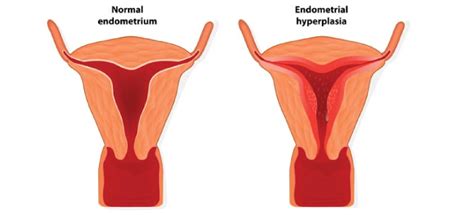 endometrial hyperplasia causes symptom diagnosis and more