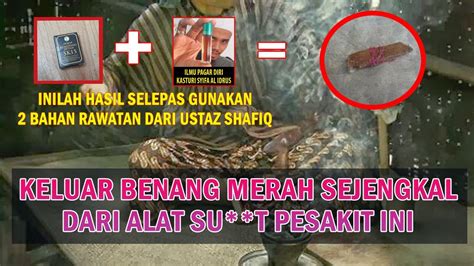 mengejutkan sejengkal benang keluar  keman pesakit  youtube