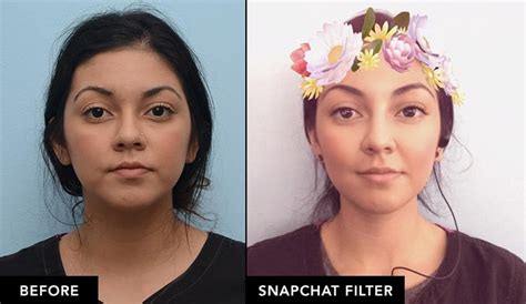 Dermal Fillers And Botox Vs Snapchat Filters In The San Francisco Bay