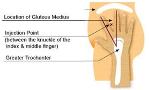 ventrogluteal injection site healthproadvice