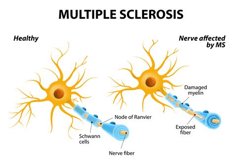 multiple sclerosis zyversa therapeutics