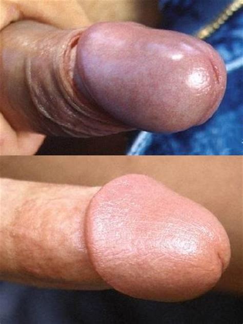 circumcised vs uncircumcised penis sex