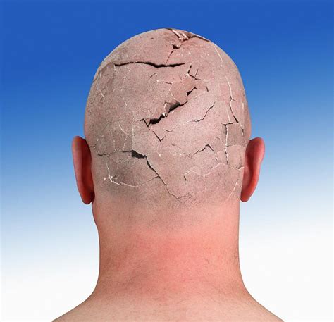 person  cracked head photograph  victor de schwanbergscience