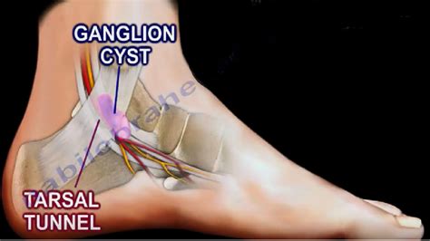 dr nabil ebraheims blogspot ganglion cyst   foot ankle