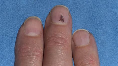 melanom nokta subungvalni melanom kako izgleda simptomi lecenje simptomi bolesti