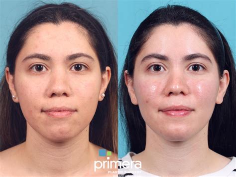 buccal fat removal  orlando winter park fl primera plastic surgery