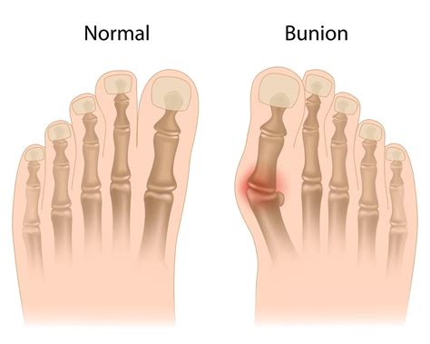 explainer    bunion        treated