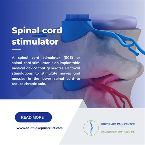 spinal cord stimulator benefits procedure  treatment  southlake