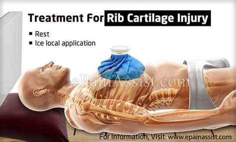Rib Cartilage Injury Treatment Causes Symptoms Diagnosis