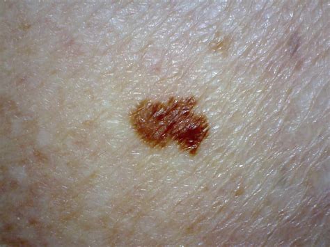 melanoma stage means