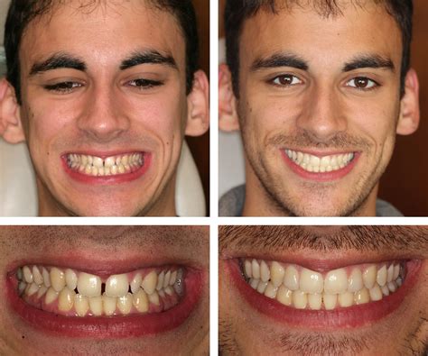 hector invisible brace teeth whitening and porcelain