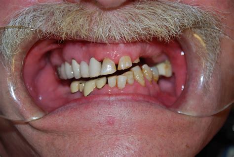 everett partial dentures  avenue dental