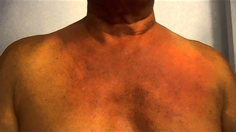 Itchy Rash On Upper Chest