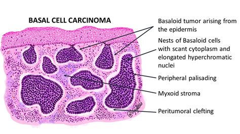 basal cell carcinoma histology diagram braun  glider  xxx hot girl