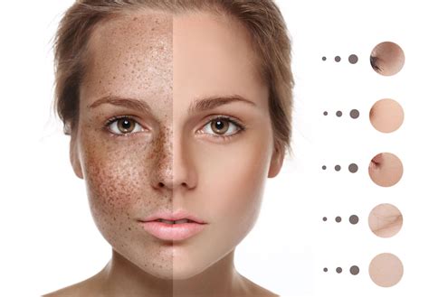 types  pigmentation   caused  skinmatters