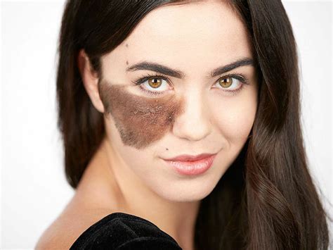 dancer cassandra naud with birthmark on face embraces her beauty