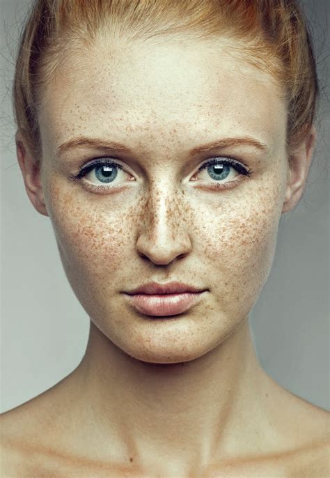 freckle  skin blog  anum