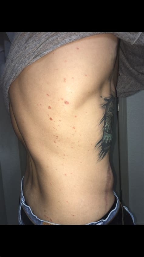 hiv rash really scared sexual health forums patient