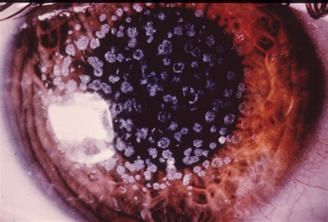 corneal dystrophy granular hereditary ocular diseases