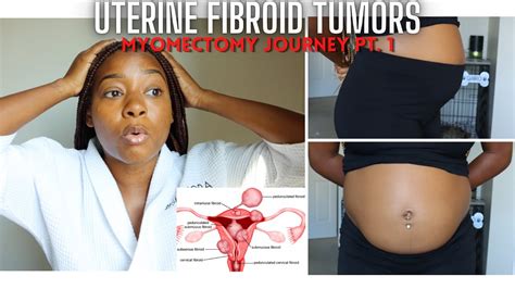 Massive Fibroid Tumors Journey My Symptoms Diagnosis And Pre Op