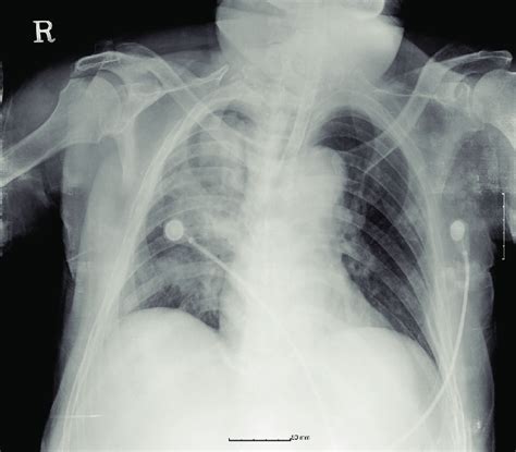 Chest X Ray Image Taken 1 Hour After The Operation Right Upper Lobe