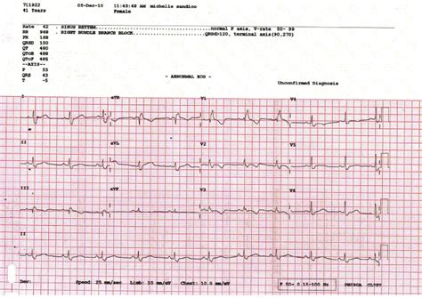 Ecg Tracing Of The Same Patient After Colon Clear Download