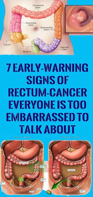 don t ignore these 6 signs that may indicate anal cancer healthy