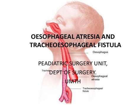 Eosophageal Atresia Tracheo Esophageal Fistula