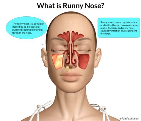 runny nose  rhinorrhea   allergy   nasal