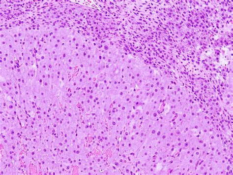 pathology outlines corpus luteum cyst