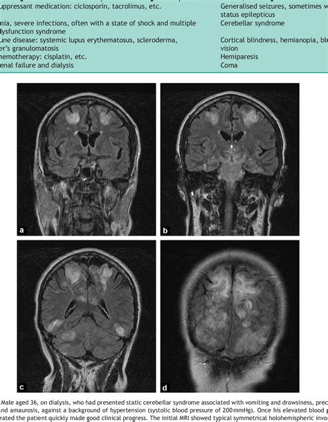 figure   posterior reversible encephalopathy syndrome pres features  ct