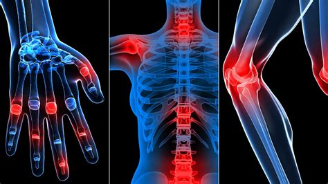 Rheumatic Disease Awareness Month 2019 Rheumatoid Arthritis