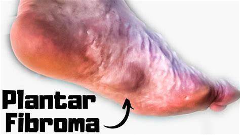 bump on the bottom of my foot [plantar fibroma treatment and massage ]