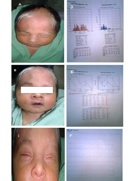case  waardenburg syndrome type  international journal  clinical medical images