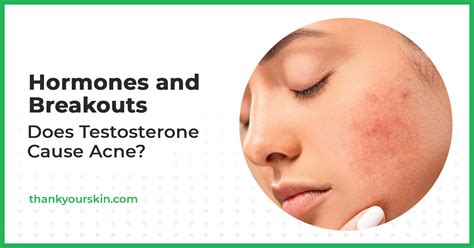 Does Testosterone Cause Acne Blame Your Hormones