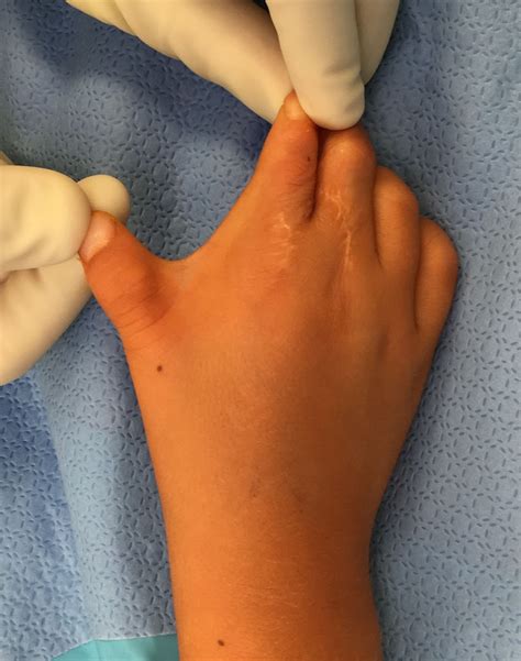 skin contracture   plasty correction congenital hand  arm