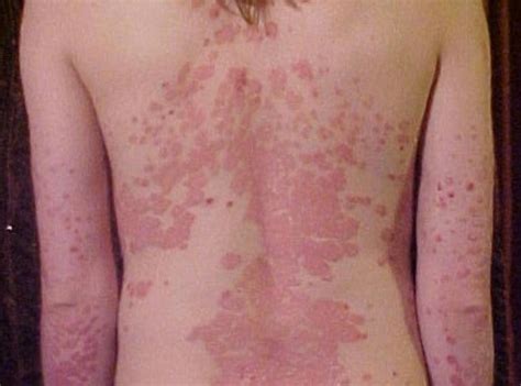 psoriasis causes triggers diagnosis and treatment