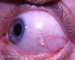 bump   eye part  conjunctival cyst eyedolatry