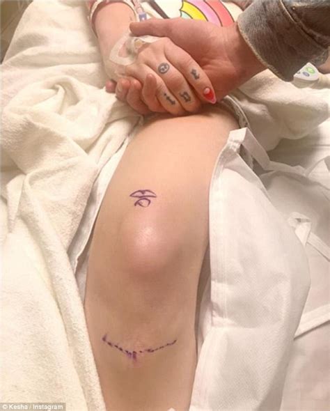Kesha Reveals Painful Looking Scar On Her Knee After Acl